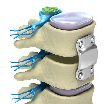 "Spinal Fixation System"